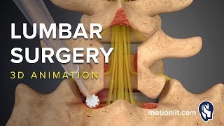 Lumbar Surgery  Laminectomy  3D Medical Animation [upl. by Rorrys137]