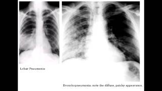 Lobar Pneumonia amp Bronchopneumonia  Organisms amp Characteristics [upl. by Nywroc]