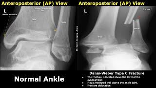 DanisWeber Classification of Ankle Fractures XRay Normal Vs Abnormal Images  Fibular Fractures [upl. by Naltiac]