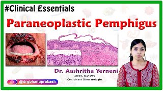 Paraneoplastic pemphigus Clinical essentials Dr Aashritha yerneni [upl. by Ecinuahs]