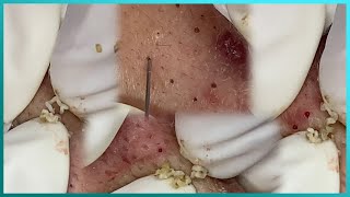 Big Cystic Acne Blackheads Extraction Blackheads amp Milia Whiteheads Removal Pimple Popping [upl. by Hazrit]