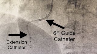 Extension Catheter to Deliver Stent in A Tortuous RCA in Acute Inferior Wall MI StepbyStep Lesson [upl. by Awhsoj979]