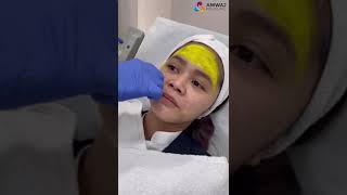 Yellow Peel  Effective For Acne Scars amp Pigmentation [upl. by Fanchette]