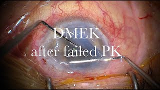 DMEK after failed PK in a vitrectomized eye [upl. by Aisyram]