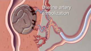 Fibroid Treatment Options  Mayo Clinic [upl. by Newfeld]