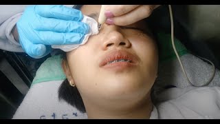 Vlog 35  Syringoma Removal  Laser Cauterization [upl. by Lerred624]