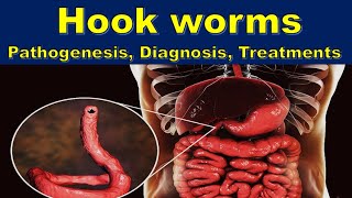 Hook worms  Ancylostoma duodenale  Necator americanus  Pathogenesis Diagnosis Treatments [upl. by Bartholemy]