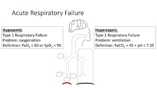 Acute Respiratory Failure [upl. by Goar]