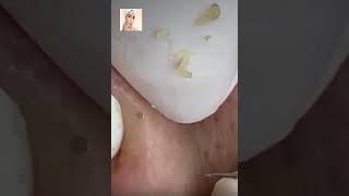 Blackheads Removal  Acne Treatment and Very Satisfying Satisfying Pimple pop blackheads [upl. by Eirena]