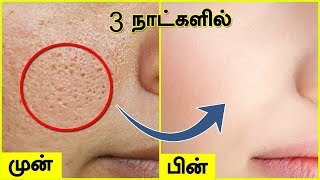 முகத்தில் உள்ள சிறுசிறு குழிகள் OPEN PORES மறைய  Open Large Pores on Face [upl. by Helge]