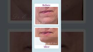 Before amp After filler Injection [upl. by Mcgannon]