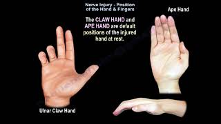 Nerve Injury Position of the Hand amp Fingers  Everything You Need To Know  Dr Nabil Ebraheim [upl. by Holton]