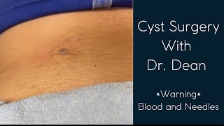 Cyst removal with Dr Dean [upl. by Navis]