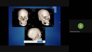 Plastiquest Case DiscussionAmeloblastoma Mandible 1 [upl. by Barclay]