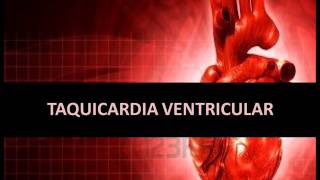 Arritmias cardíacas  Taquicardia ventricular [upl. by Mandell]