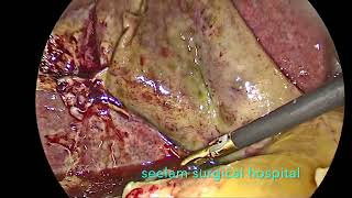 Laparoscopic Cholecystectomy For Acute Gangrenous Cholecystitis [upl. by Mercorr]