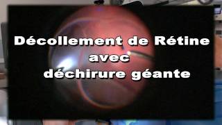 Opération de décollement rétine avec déchirure géante supérieure Dr PierreAndré DUVAL [upl. by Pfister]