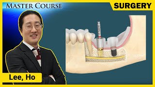 Master Course Season2  SURGERY One485 KIT for Mandibular Posterior Region [upl. by Clippard153]