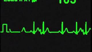 Atrial Trigeminy  ECG Simulator  Arrhythmia Simulator [upl. by Marguerite53]