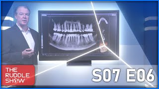 S07 E06  ExtraCanal Invasive Resorption Special Case Report by Dr Terry Pannkuk [upl. by Hackett]