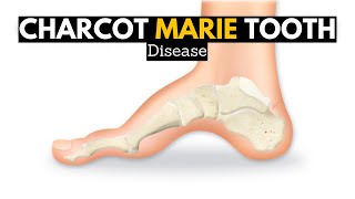 CHARCOT MARIE TOOTH DISEASE CMT [upl. by Nooj625]