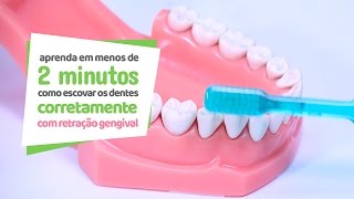 Como escovar os dentes com retração gengival  Cir Hospital Odontológico [upl. by Wildee]