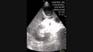 VSCAN Cholecystitis pocket ultrasound Colecistitis aguda eco de bolsillo [upl. by Dercy]