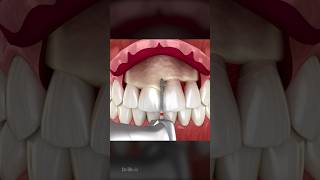 Frontal Crown Lengthening Dental Procedure [upl. by Sinnel]