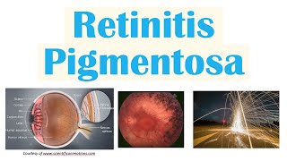 Retinitis Pigmentosa  Genetics Pathophysiology Signs amp Symptoms Diagnosis Treatment [upl. by Pacifa]