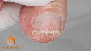 Extremely dry and inflexible skin  Nail clipping and excess skin removal in the medial grooves [upl. by Nuy523]