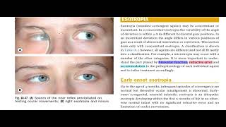 Kanski Clinical Ophthalmology Made Easy  Strabismus 8 [upl. by Tezil]