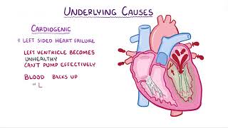 Pulmonary Edema causes symptoms diagnosis treatment pathology [upl. by Hnoj]