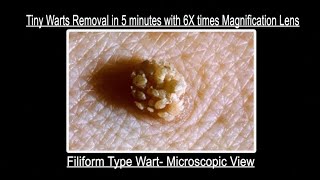 Filiform Type tiny Wart removal in 5 minutes with 6x times magnification lens Contact 9700020802 [upl. by Winifred652]