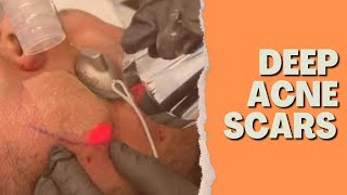 DEEP AND FRACTIONAL ERBIUM LASER FOR DEEP ACNE SCAR TREATMENT  Dr Jason Emer [upl. by Ahsaeym285]