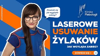 Laserowe usuwanie żylaków  jak wygląda zabieg [upl. by Ettigirb]