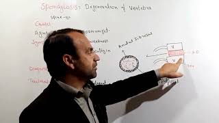 Spondylosis  Causes symptoms and treatment of Spondylosis  Skeleton disorders class 12 [upl. by Eseryt]