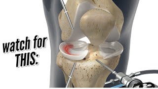 Meniscus Repair vs Meniscectomy [upl. by Demb938]