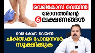 വെരികോസ് വെയിൻ രോഗത്തിന്റെ 6 ലക്ഷണങ്ങൾ  Varicose veins Malayalam Video [upl. by Nereil568]