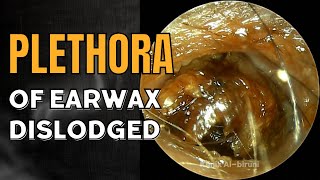 Plethora of Earwax Dislodged [upl. by Jaan]