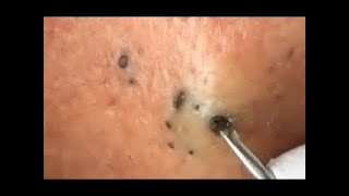 LARGE Blackheads Removal [upl. by Meeker]