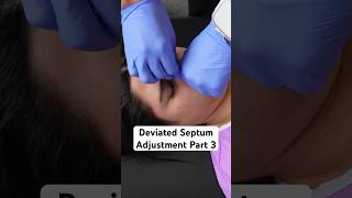 Years of difficulty breathing alleviated Deviated Septum Adjustment Part 3 DrRahim shorts [upl. by Submuloc310]