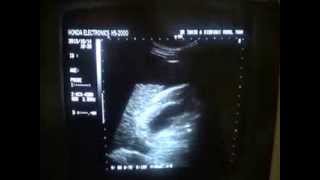 CIRRHOTIC LIVER ultrasound study [upl. by Decamp221]