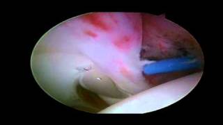 Labral Tear  Detached Anterior Labrum [upl. by Hayott]