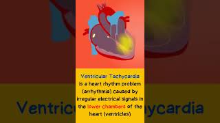 Ventricular Tachycardia heart shorts [upl. by Rafaelita]