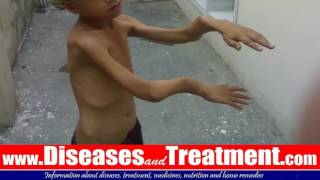 Rickets and Osteomalacia Soft Bones   Causes Symptoms  Treatment [upl. by Samson]