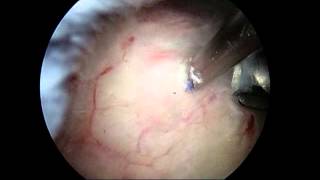 Arthroscopic removal of calcium deposit from shoulder calcific tendonitis [upl. by Sugna]