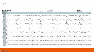 EEG Atlas B2 Become a Comfortable EEG Reader Using The Ceribell Rapid Response System [upl. by Ayoral268]