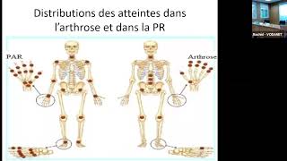 quot Rhumatisme inflammatoire et rhumatisme dégénératif savoir faire la différence » Dr ABoukabous [upl. by Cida]