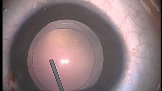 Pediatric Cataract Surgery Lens Aspiration PCCC Anterior Vitrectomy and IOL Implanation [upl. by Anoli]