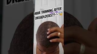 Hair Loss After Dreadlocks  Traction Alopecia👀 alopeciajourney [upl. by Nwahsor]